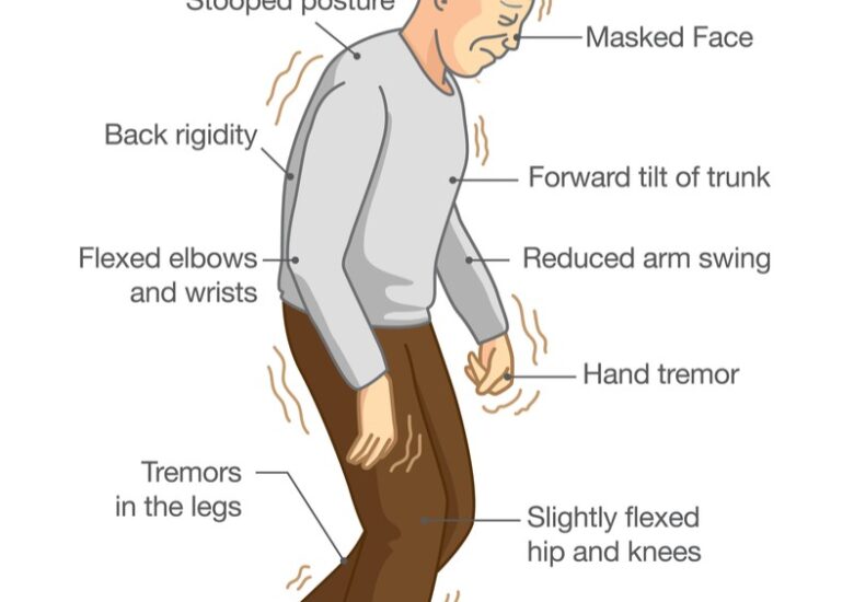 Boala Parkinson avansată