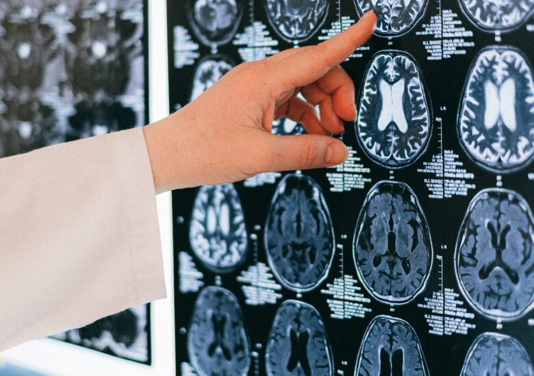 Modelele 3D de creier uman ar putea accelera căutarea tratamentelor pentru scleroză multiplă