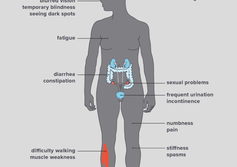 Decondiționarea în cazul persoanelor diagnosticate cu Scleroza multiplă
