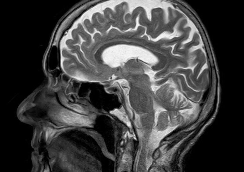 Ce este scleroza multiplă tumefactivă?