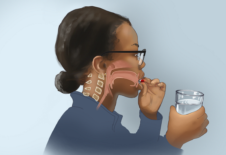 Scleroza multiplă și disfagia