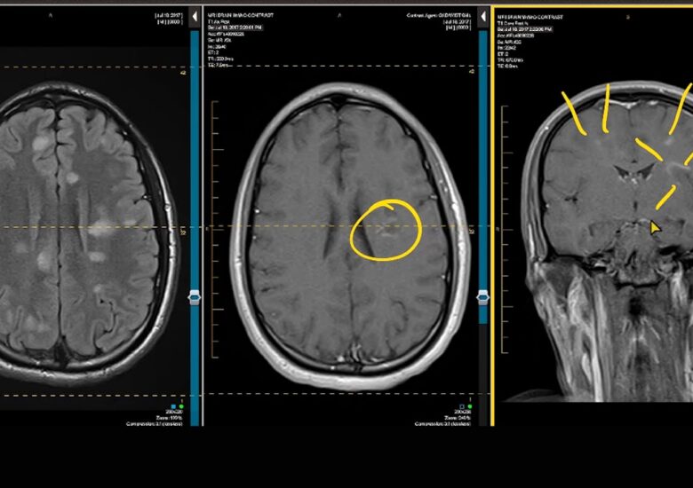 Ce este demielinizarea și ce o cauzează?