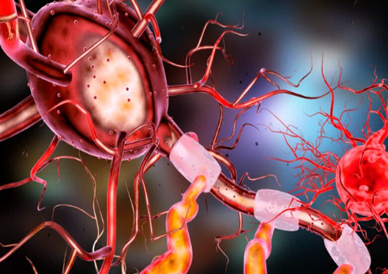 Ce este demielinizarea și ce o cauzează? Partea II