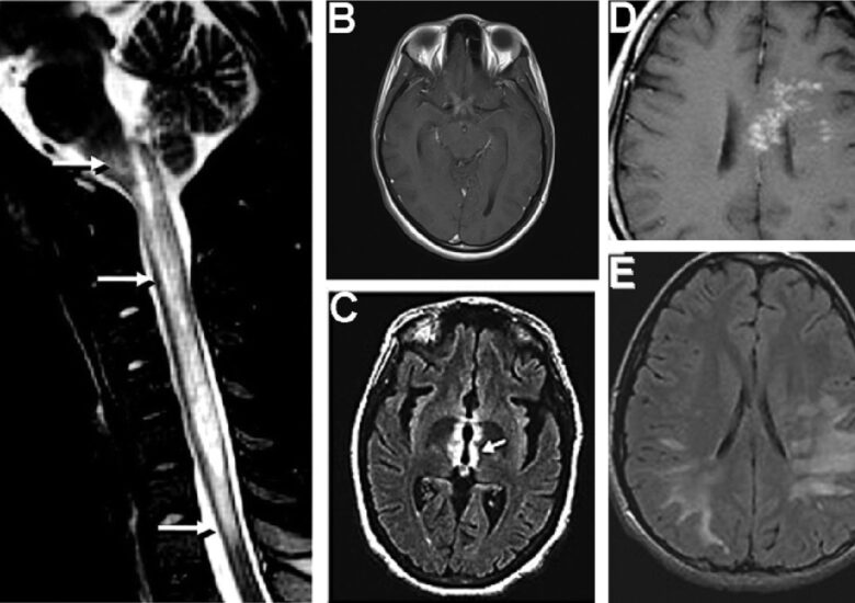 Tulburarea autoimună neuromielita optică (NMO)