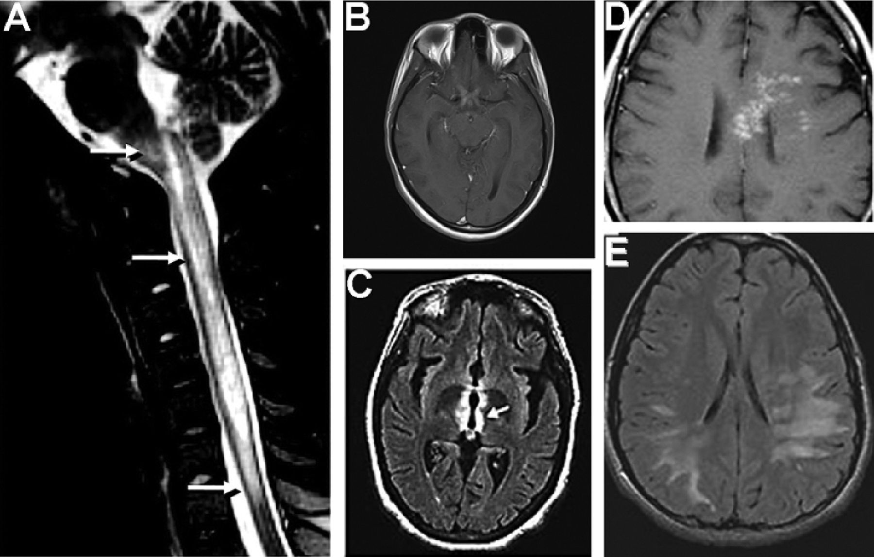 Tulburarea autoimună neuromielita optică (NMO)