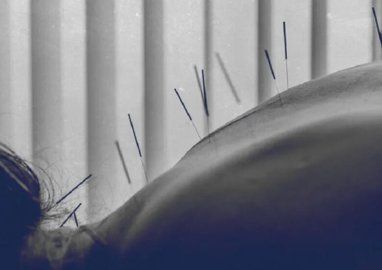 Scleroza multiplă și acupunctura: beneficii și riscuri