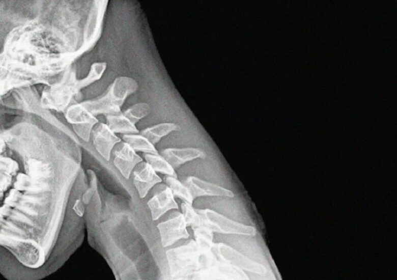 Benzi oligoclonale și scleroza multiplă: proteine din lichidul cefalorahidian