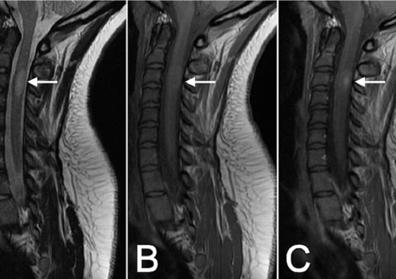 Leziunile sclerozei multiple pe coloana vertebrală: Ce trebuie să știți?