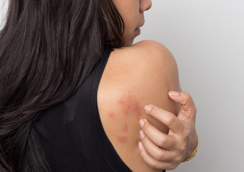 Legătura dintre scleroza multiplă și urticarie