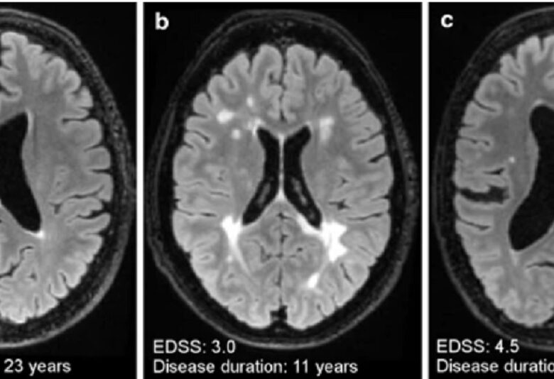 Leziuni cerebrale provocate de scleroza multiplă: cauze, simptome și imagini