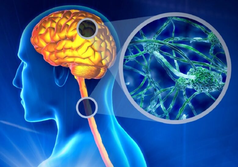 Ce spun cele mai recente cercetări despre scleroza multiplă?