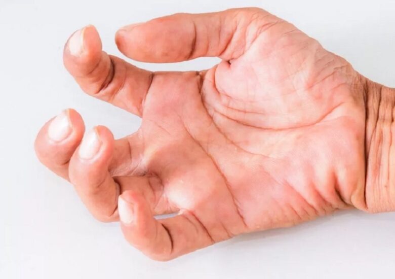 Cum sunt afectați mușchii atunci când aveți scleroza multiplă: slăbiciune, spasticitate și probleme de echilibru