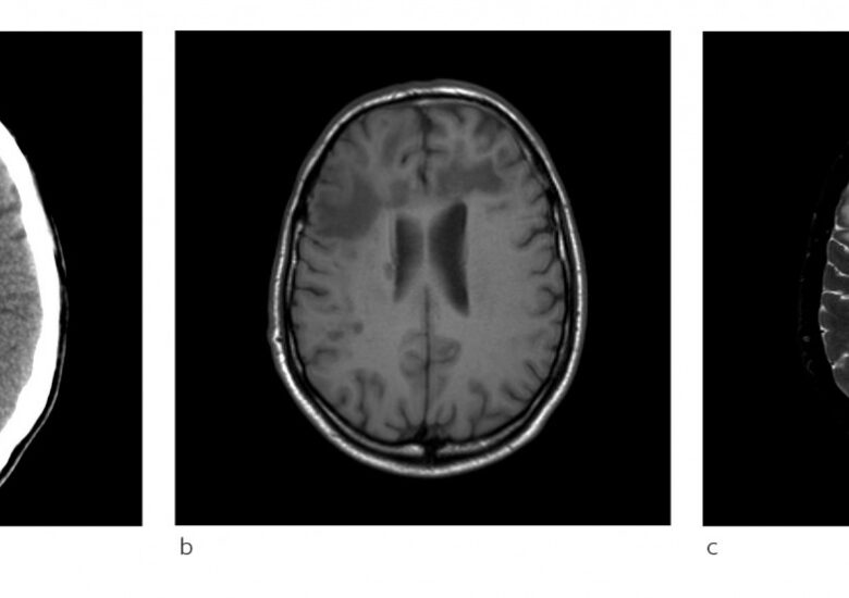 O prezentare generală a leucoencefalopatiei multifocale progresive (LMP). O infecție gravă a creierului