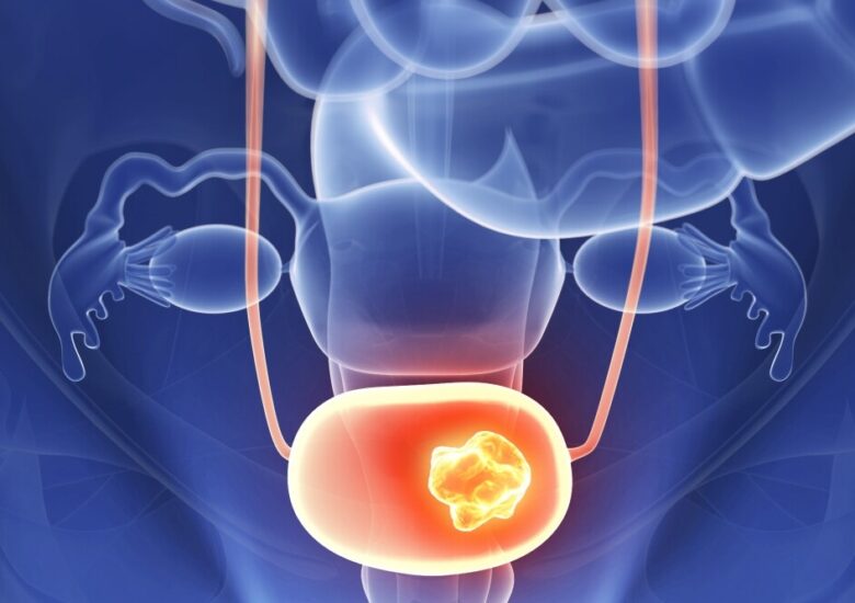 O privire de ansamblu asupra disfuncției vezicii urinare în Scleroza Muliplă
