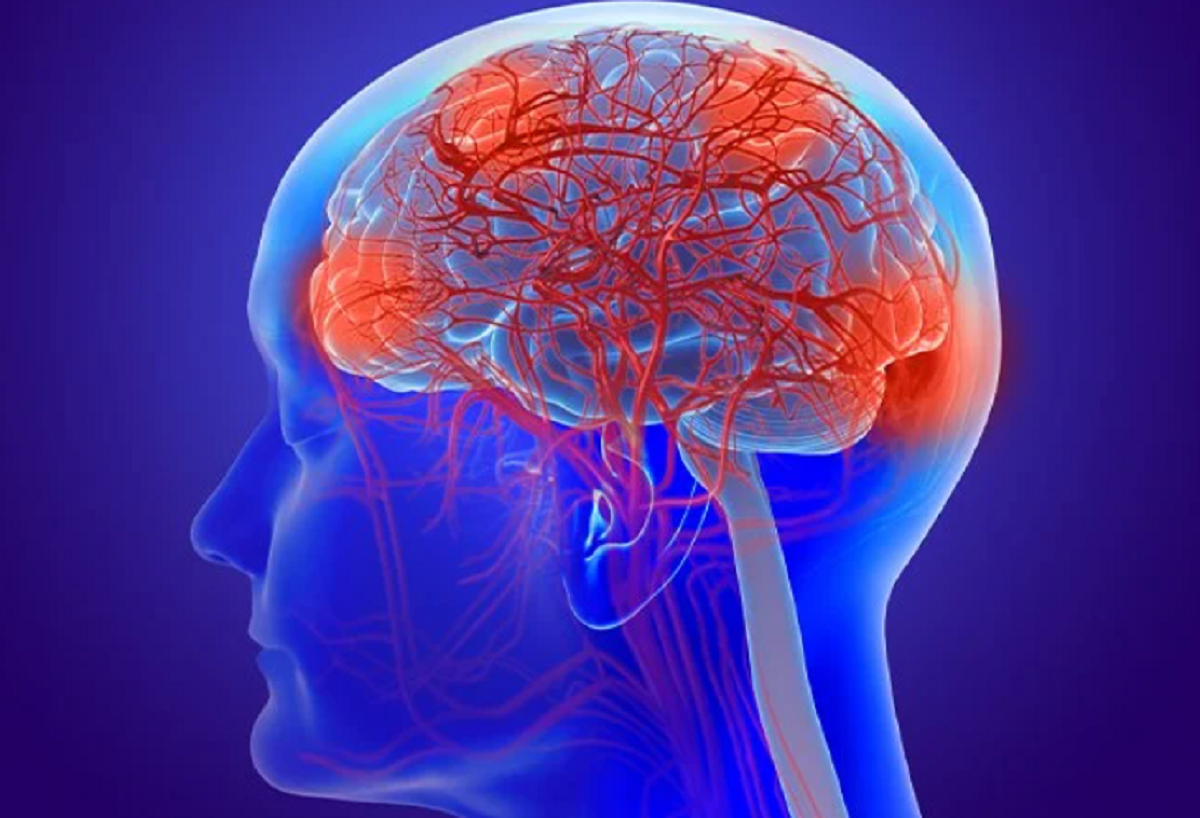 Leziuni cerebrale ale sclerozei multiple și efectele lor. Cum poate afecta scleroza multiplă trunchiul cerebral