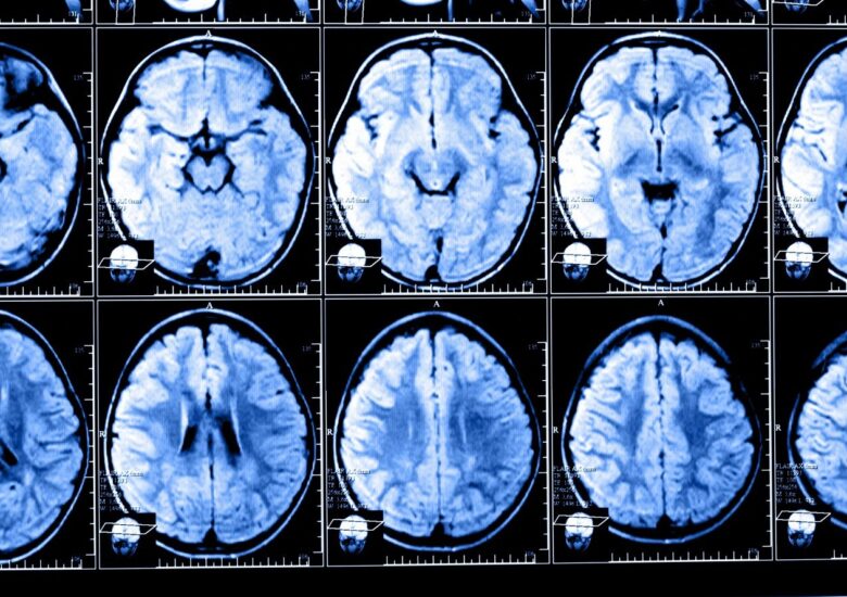 Ce sunt leziunile care intensifică gadoliniul în scleroza multiplă?