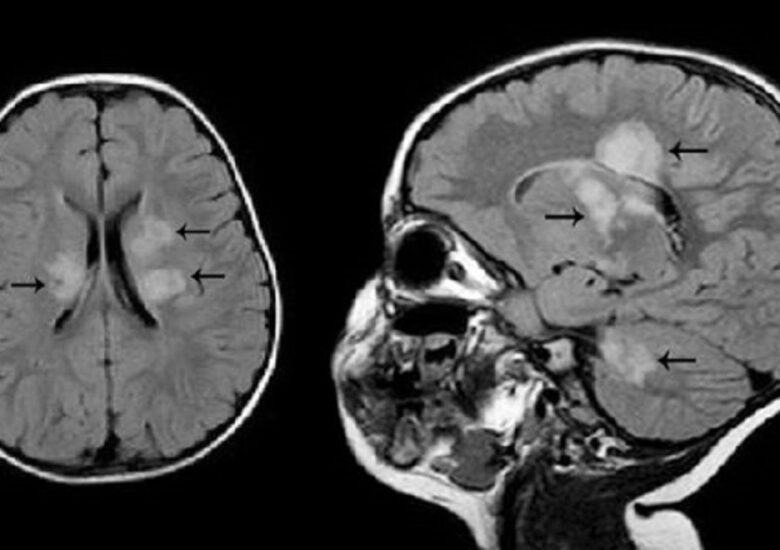 Scleroza multiplă (SM) la adulții tineri