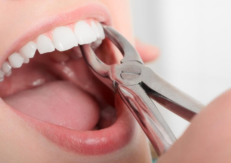 Tot ce trebuie să știi despre scleroza multiplă și extracțiile dentare