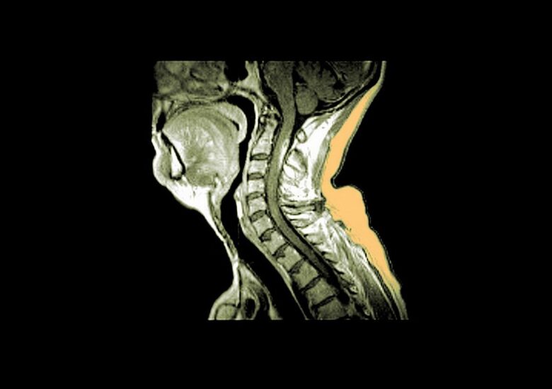 Când scleroza multiplă atacă măduva spinării
