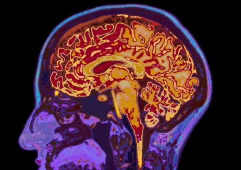 Semne timpurii ale sclerozei multiple